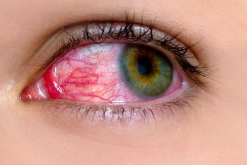 علت قرمز شدن سفیدی چشم چیست؟