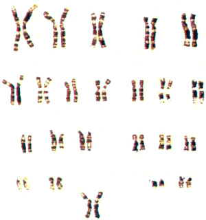 کروموزوم‌ها. این تصویر بسیار درشت‌نمائی شده از ۴۶ کروموزوم زنی بهنجار است. کروموزوم‌های شماره ۱ تا ۲۲ مردها نظیر همین جفت‌ها است اما جفت بیست و سوم آنها به‌جای XX به‌صورت XY است.