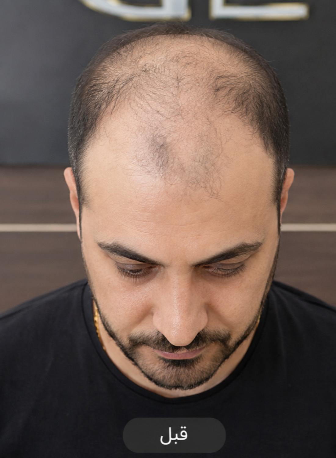 کاشت مو طبیعی