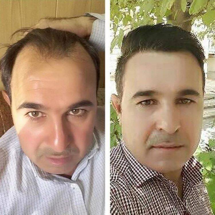 کاشت مو