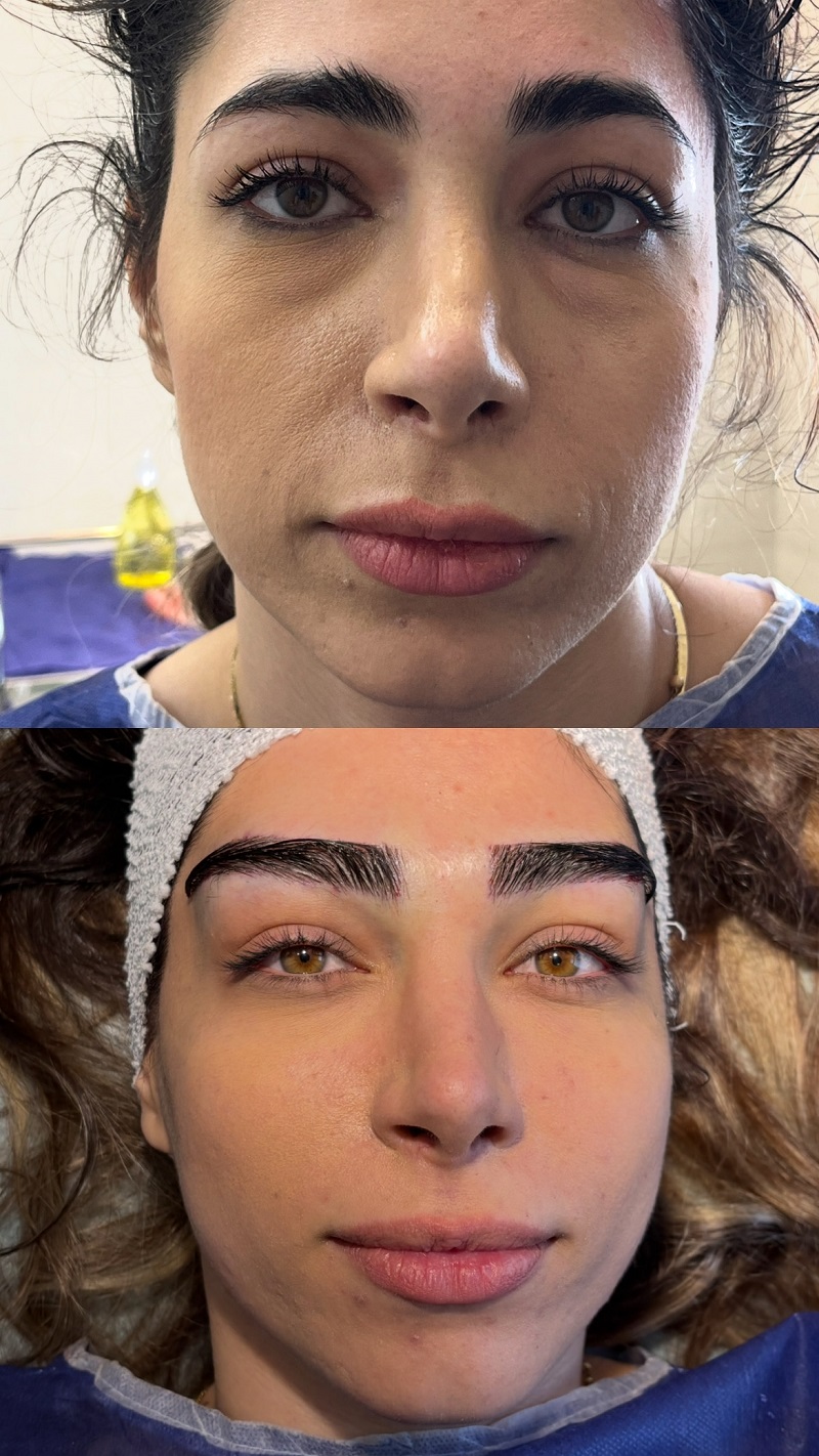 کاشت ابرو زنانه