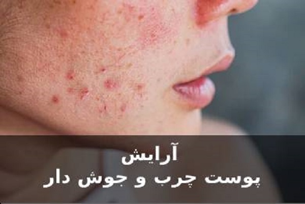 آرایش پوست چرب و جوش دار