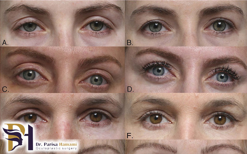 بهترین جراح بلفاروپلاستی در تهران
